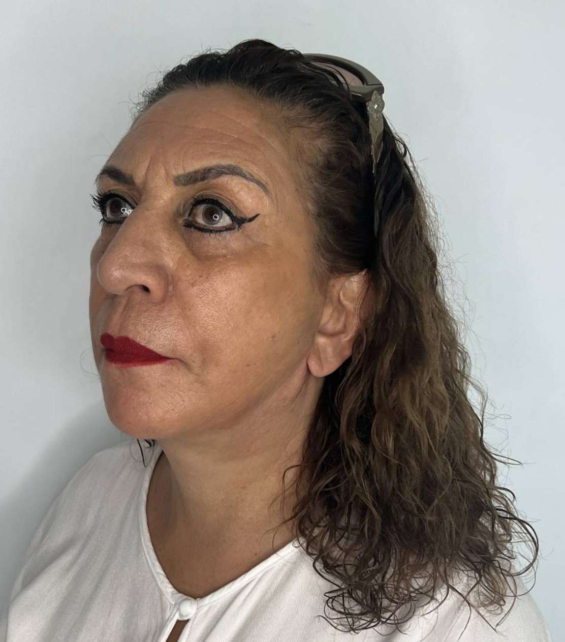 Ritidoplastia o lifting facial – antes del procedimiento | Dr. Alejandro Lozano, cirujano plástico en Neiva