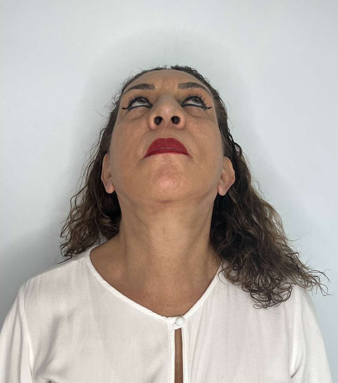 Ritidoplastia o lifting facial – antes del procedimiento | Dr. Alejandro Lozano, cirujano plástico en Neiva