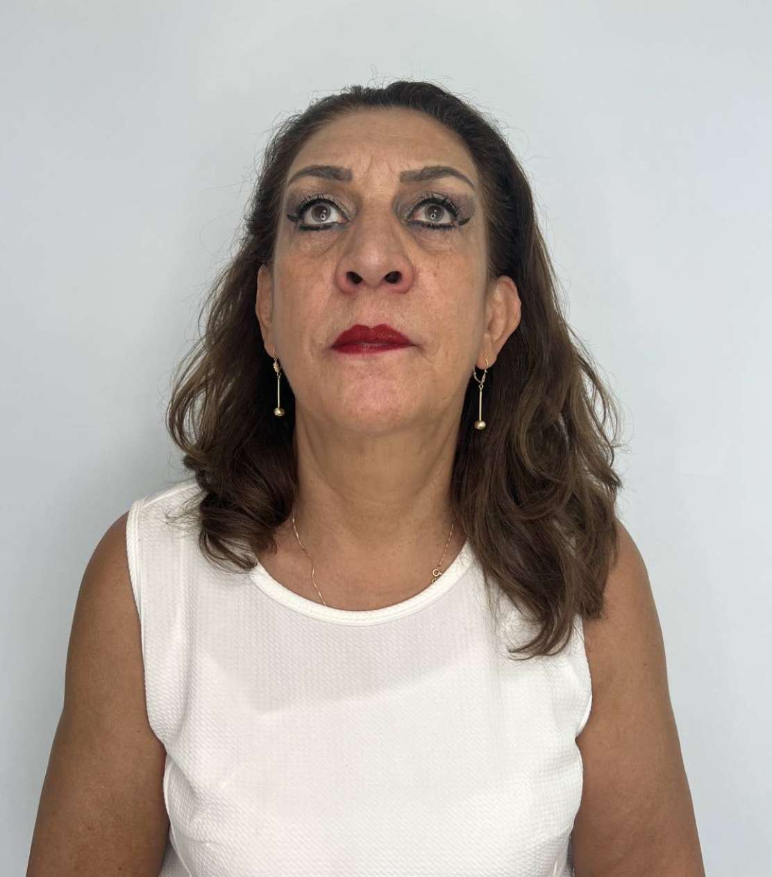 Ritidoplastia o lifting facial – después del procedimiento | Dr. Alejandro Lozano, cirujano plástico en Neiva