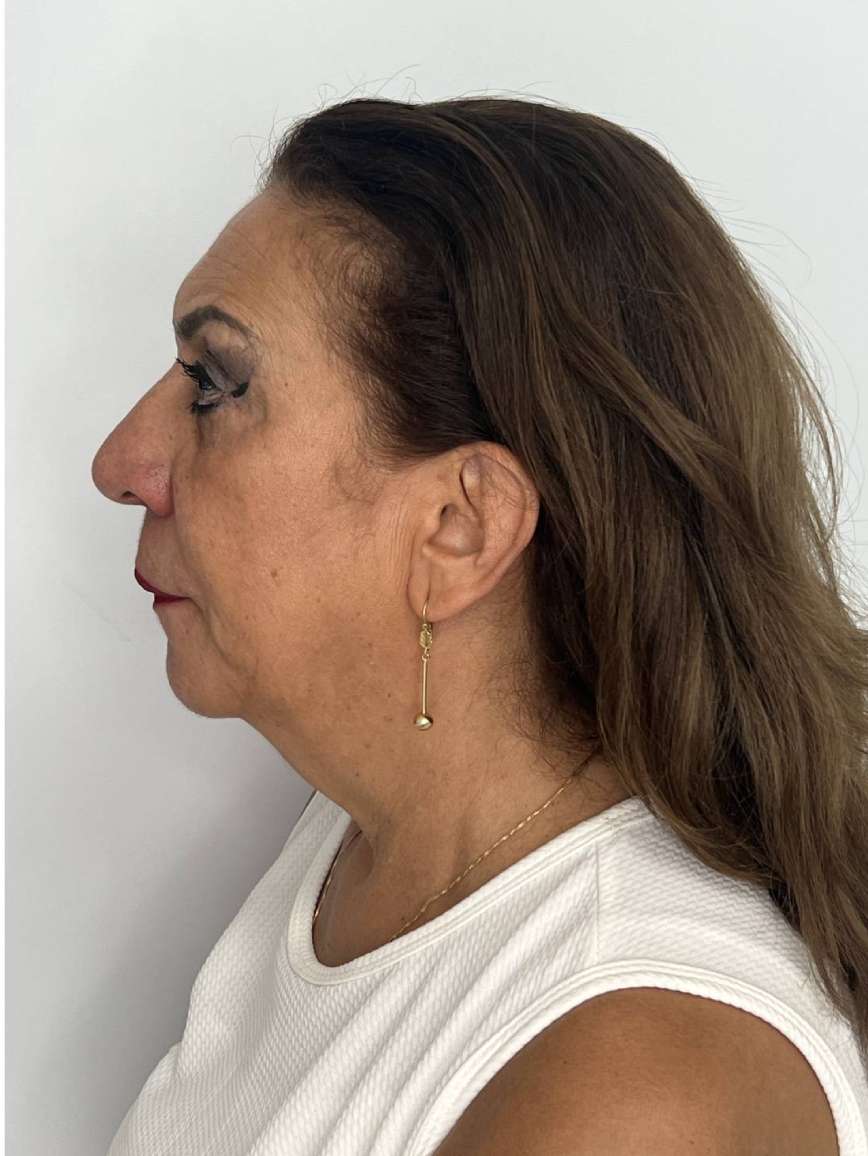 Ritidoplastia o lifting facial – antes del procedimiento | Dr. Alejandro Lozano, cirujano plástico en Neiva