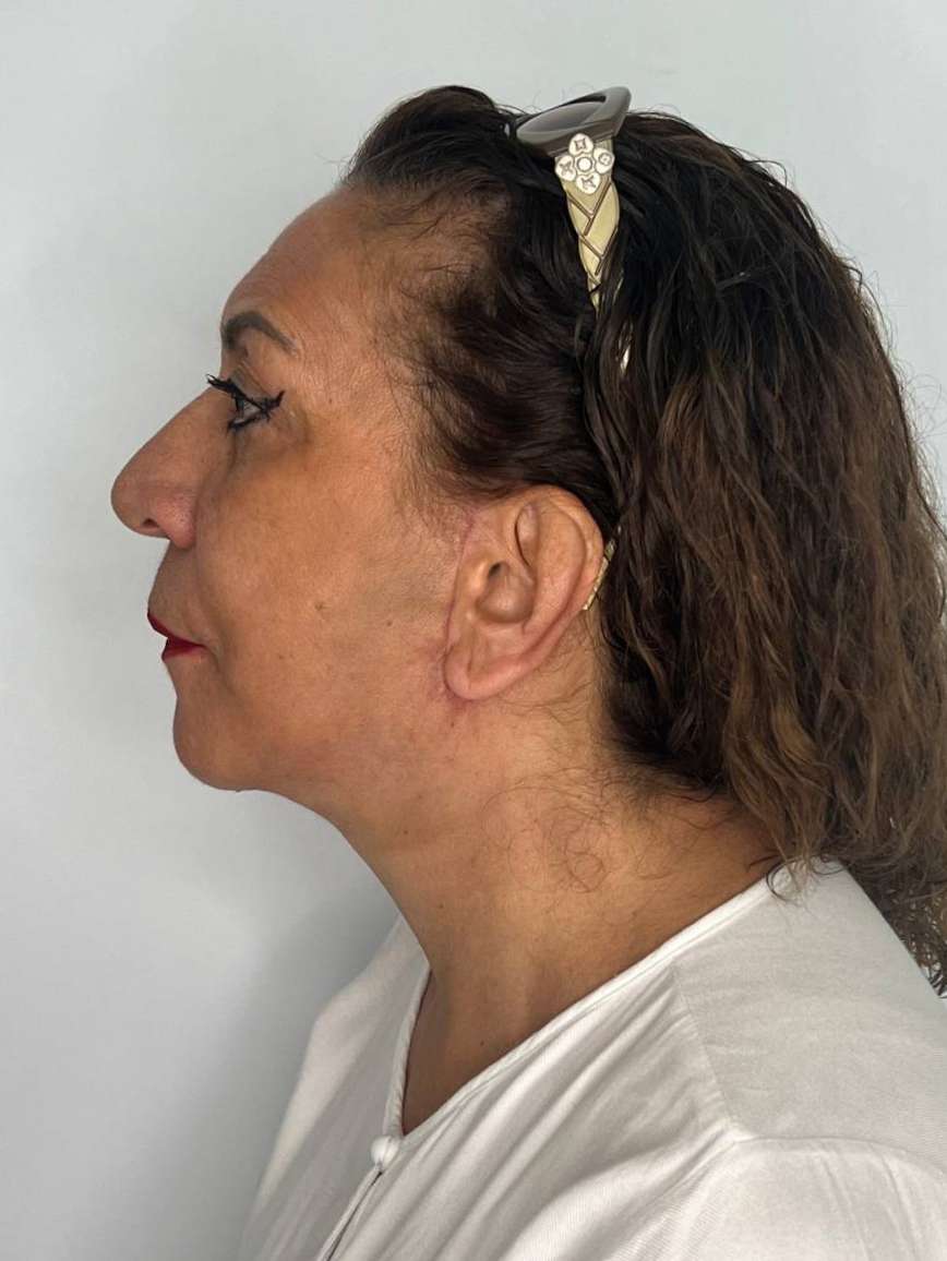 Ritidoplastia o lifting facial – después del procedimiento | Dr. Alejandro Lozano, cirujano plástico en Neiva