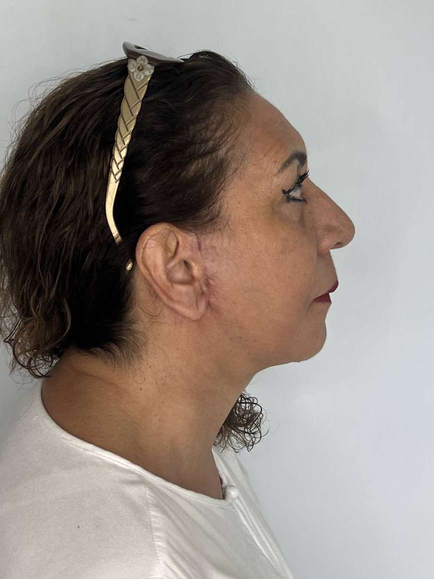 Ritidoplastia o lifting facial – después del procedimiento | Dr. Alejandro Lozano, cirujano plástico en Neiva
