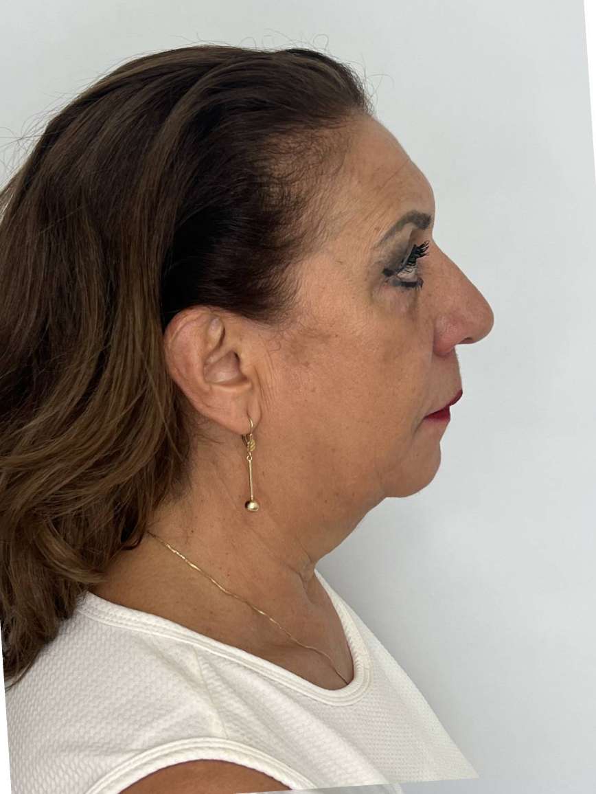 Ritidoplastia o lifting facial – antes del procedimiento | Dr. Alejandro Lozano, cirujano plástico en Neiva