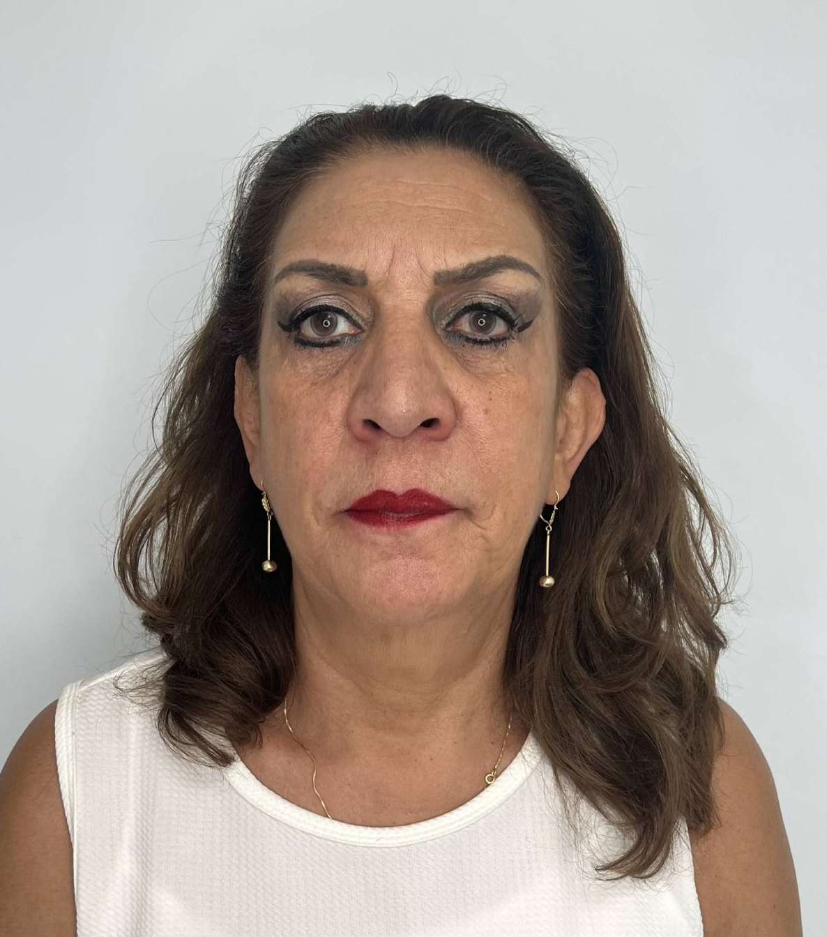 Ritidoplastia o lifting facial – después del procedimiento | Dr. Alejandro Lozano, cirujano plástico en Neiva