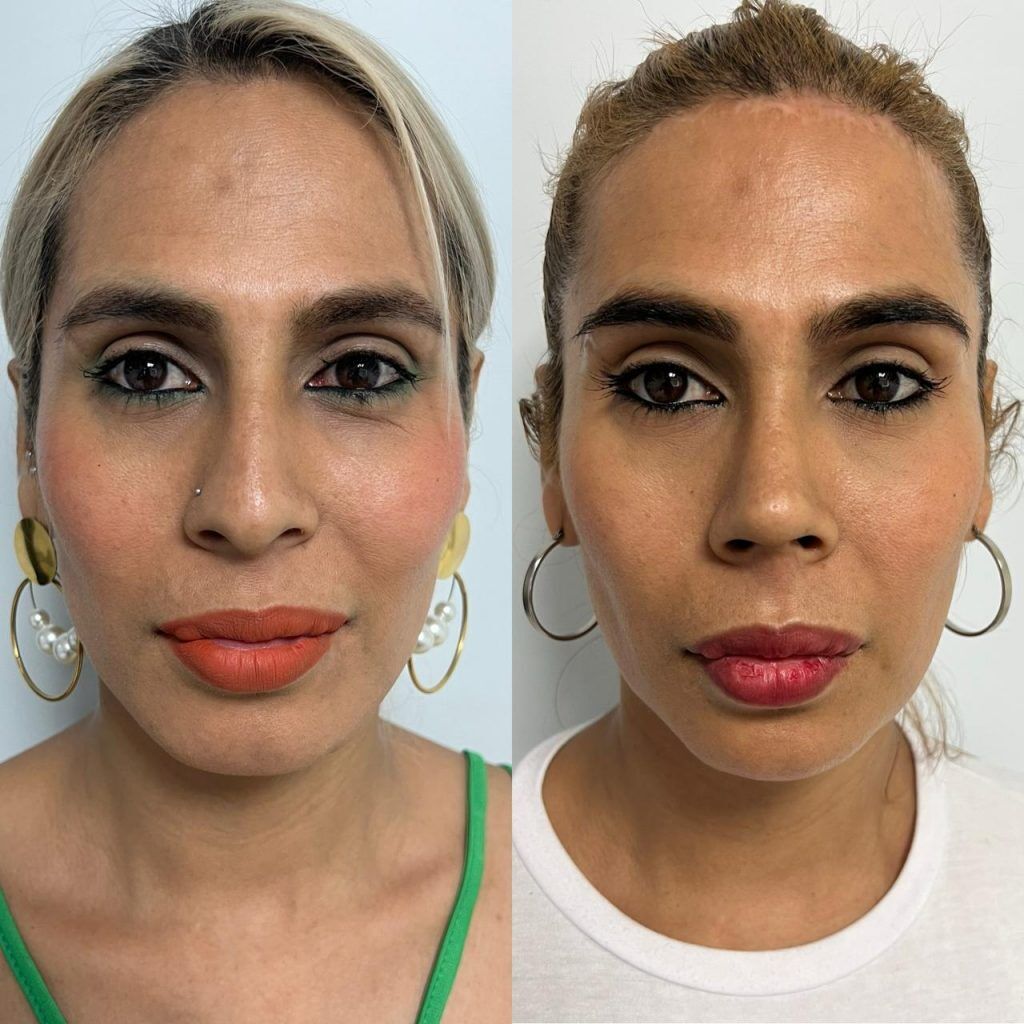 Feminización facial – antes y después, foto 1 | Dr. Alejandro Lozano, cirujano plástico en Neiva