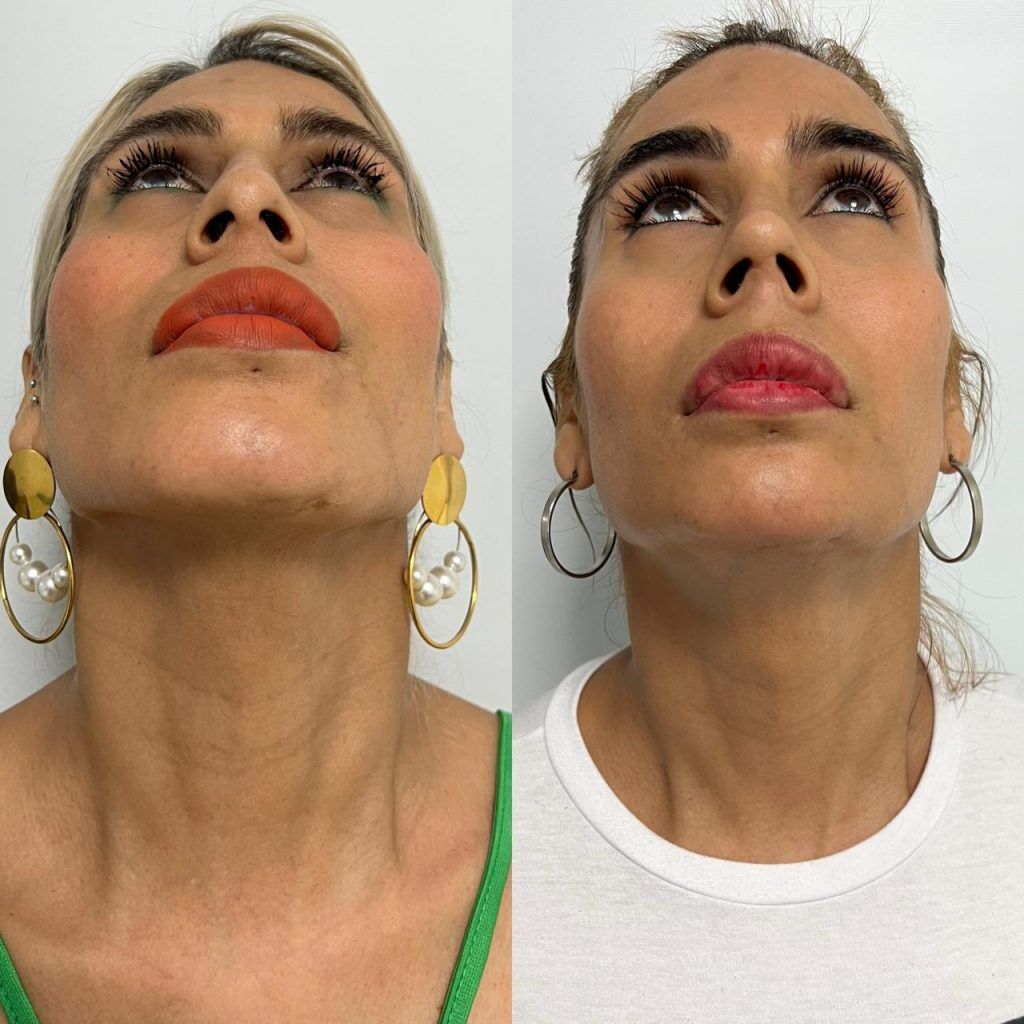 Feminización facial – antes y después, foto 2 | Dr. Alejandro Lozano, cirujano plástico en Neiva